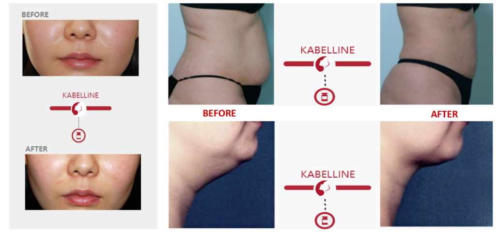Kabelline Lipolysis Solution