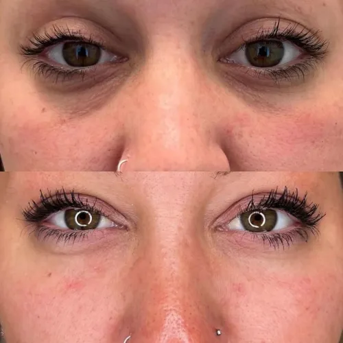 AMI Eyes